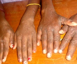TVM-HAND