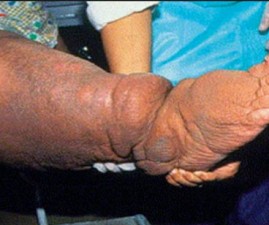 pkd-manth