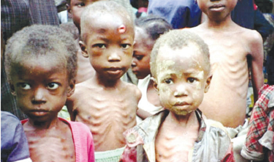 Severe-Acute-Malnutrition1